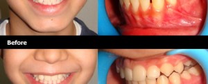 Braces-Treatment