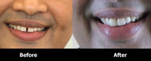 Composite-Diastema-Closure