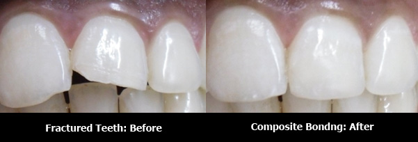 Cosmetic Fillings