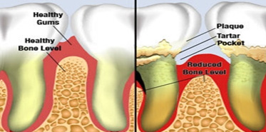 Gum Treatment