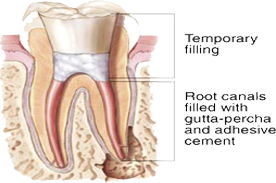 Root Canal