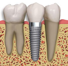 img-implants