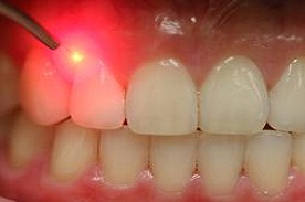 Laser Dental Treatment