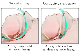 Obstructive Sleep Apnea