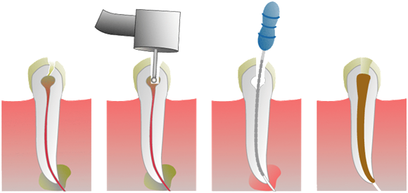 Root Canal Therapy